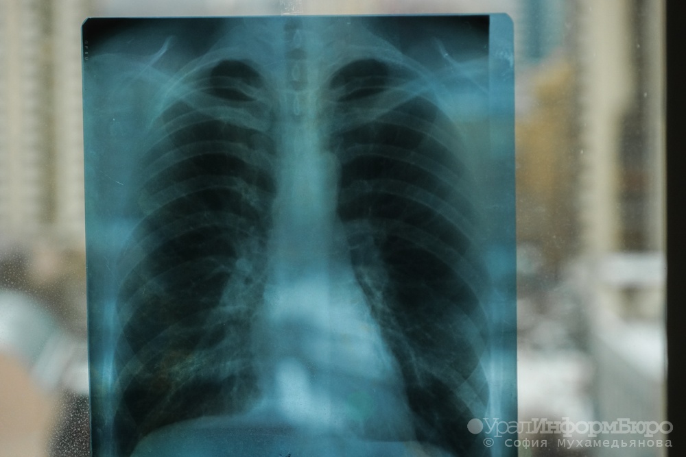 Свердловчане стали крайне редко умирать от туберкулеза